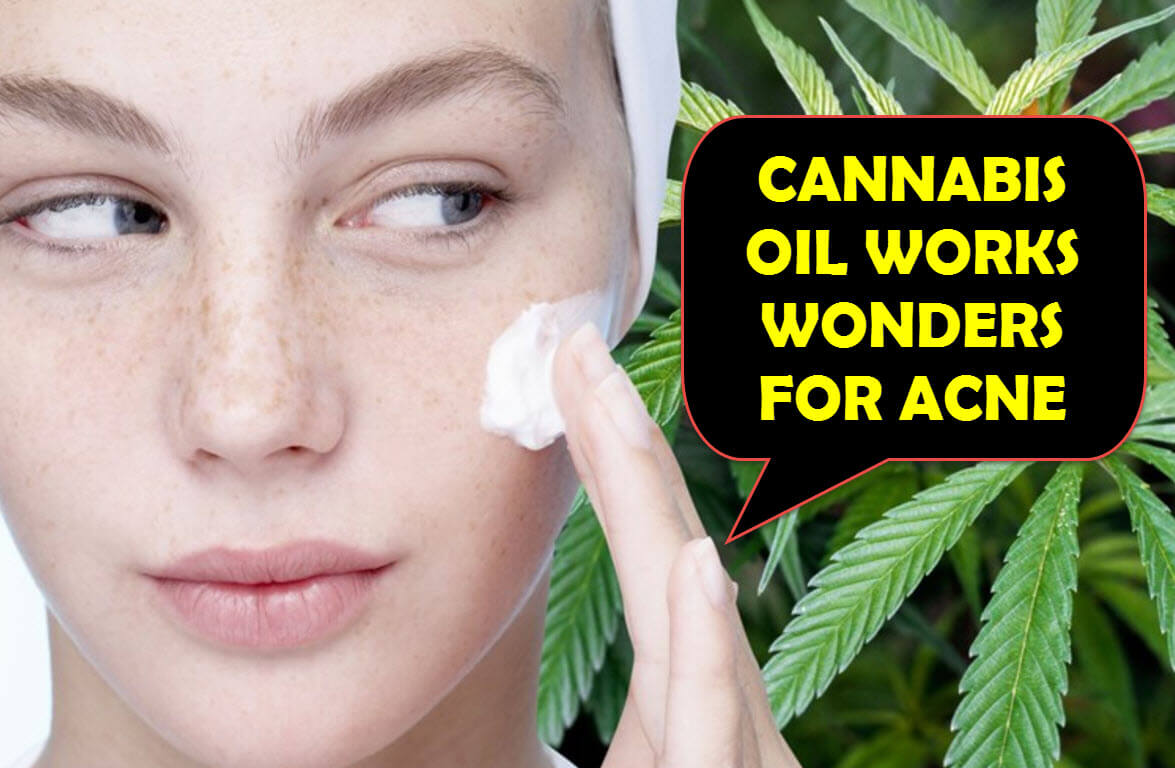 Suffering from Acne? CBD might help