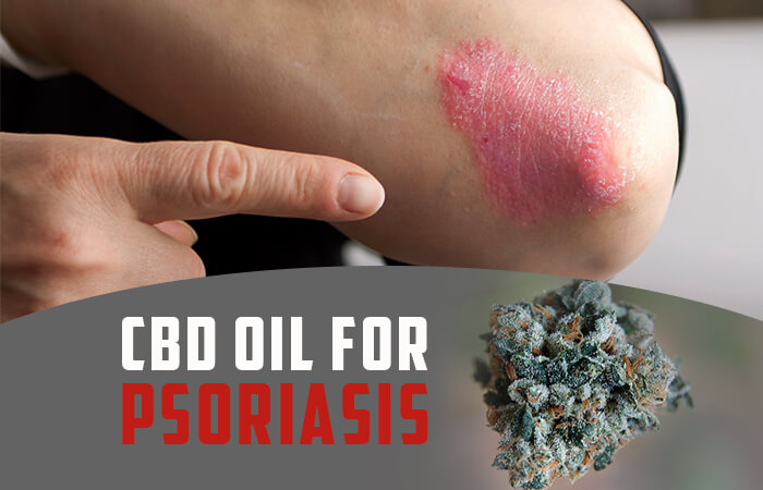 CBD for Psoriasis